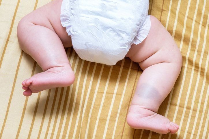 バースマーク」を持つ人を撮り続けるフォトグラファーが伝えたかったことTABI LABO