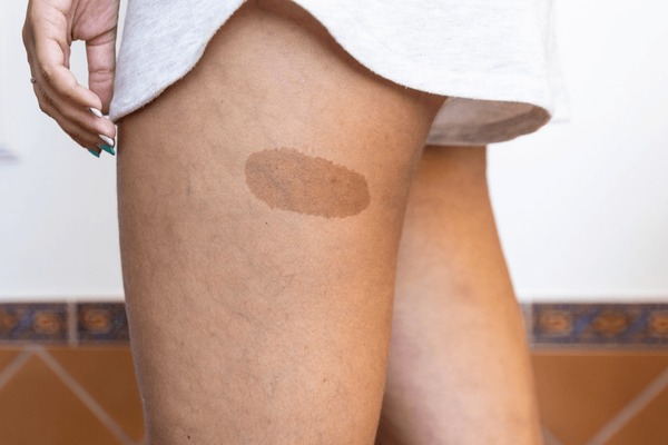 Birth mark」の1.7万点のロイヤリティフリー画像、写真素材、絵Shutterstock